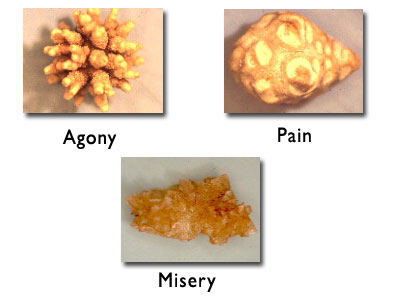 Increase  Penis on Kidney Stones Eating Some Food Frequently Can Increase Your Chances Of